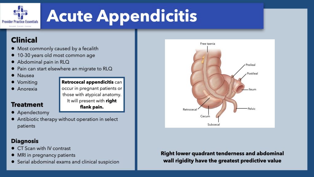 Acute Appendicitis