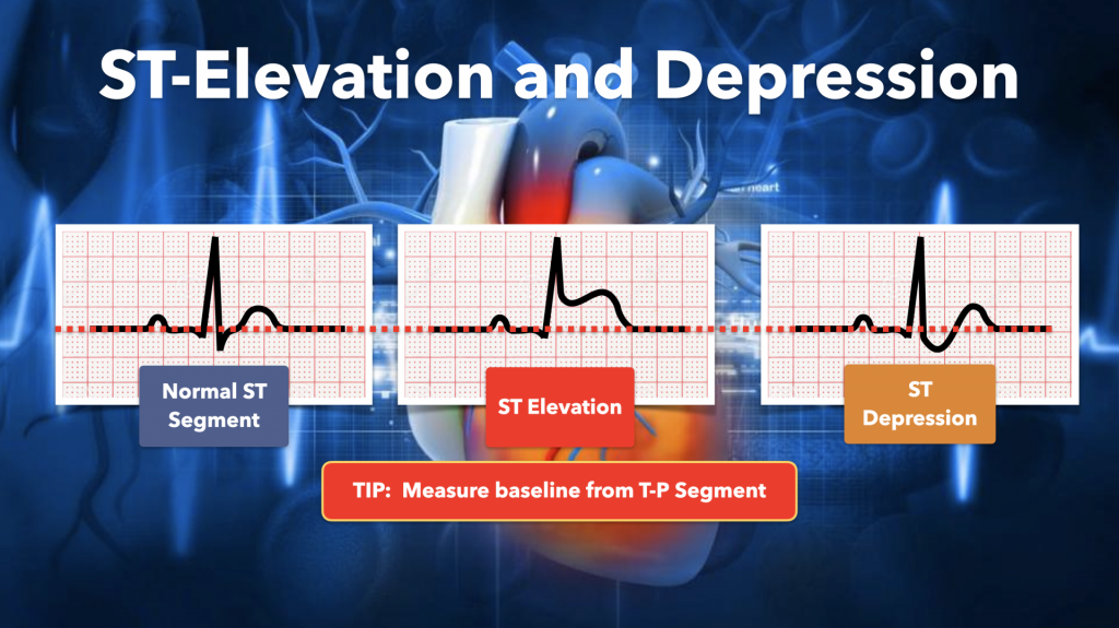 ST Elevation and Depression