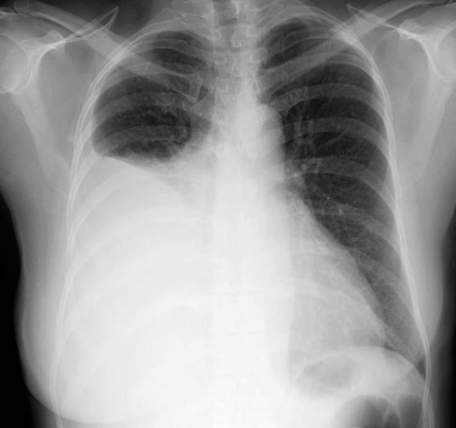 Right pleural effusion