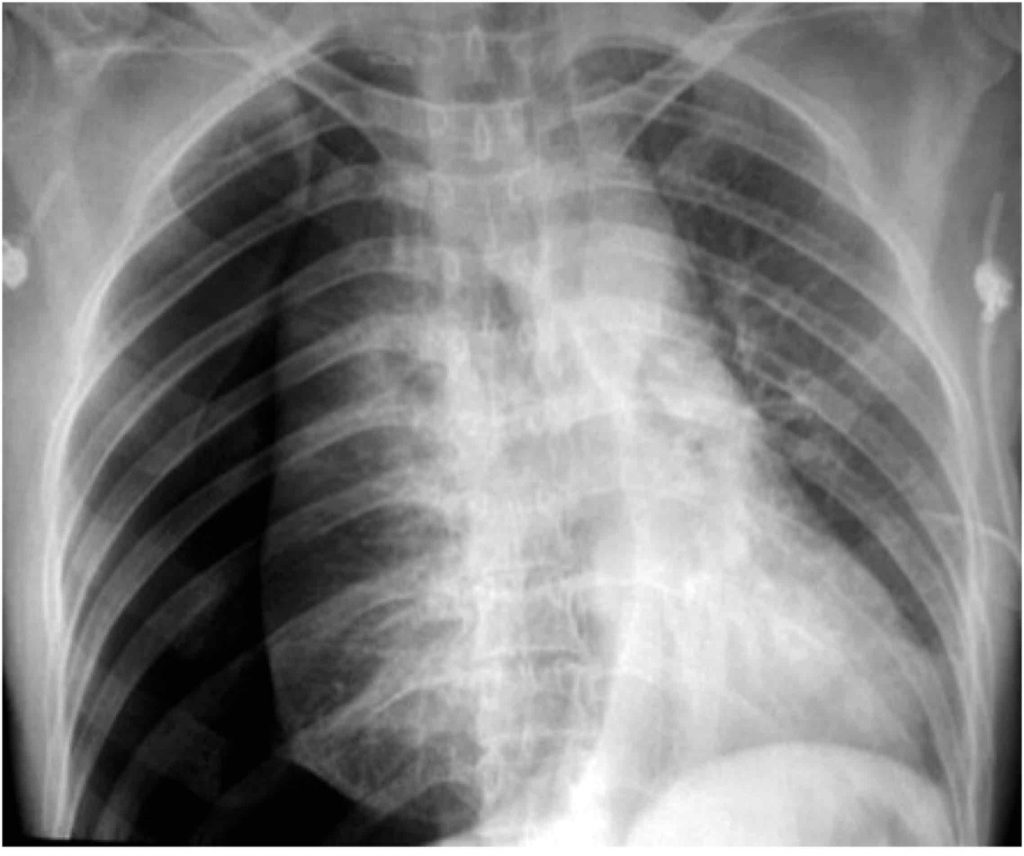 Tension Pneumothorax