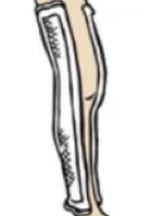 Medial-Lateral Long Leg Splint