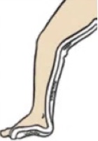 Posterior Long Leg Splint