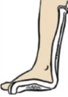 Posterior Short Leg Splint