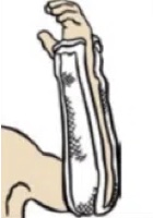 Forearm Sugar Tong Splint