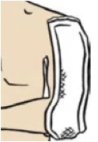 Humeral Sugar Tong Splint